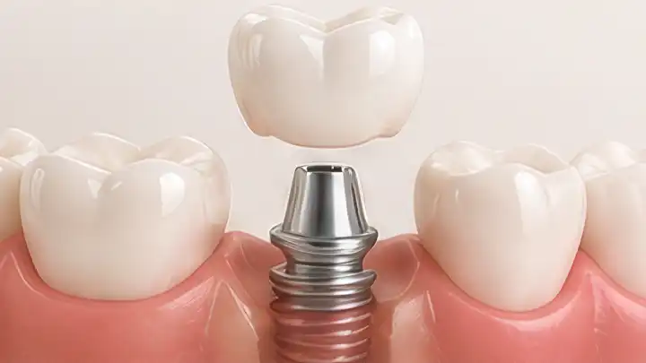 Dental Implant