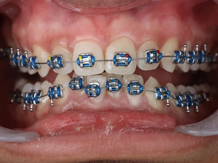 Braces